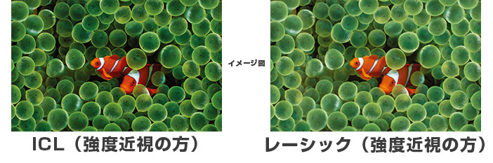 レーシックとICLの見え方の違い